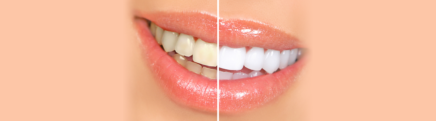 Teeth Whitening - Chingford Mount Dental Practice - London