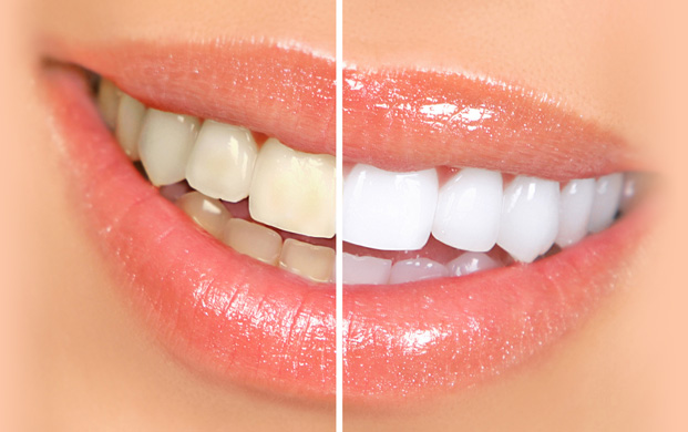 teeth-whitening