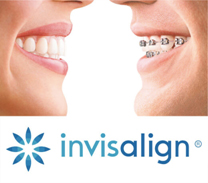 Invisalign