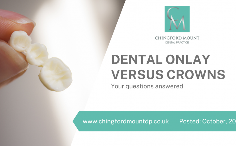 Dental Onlay Versus Crowns