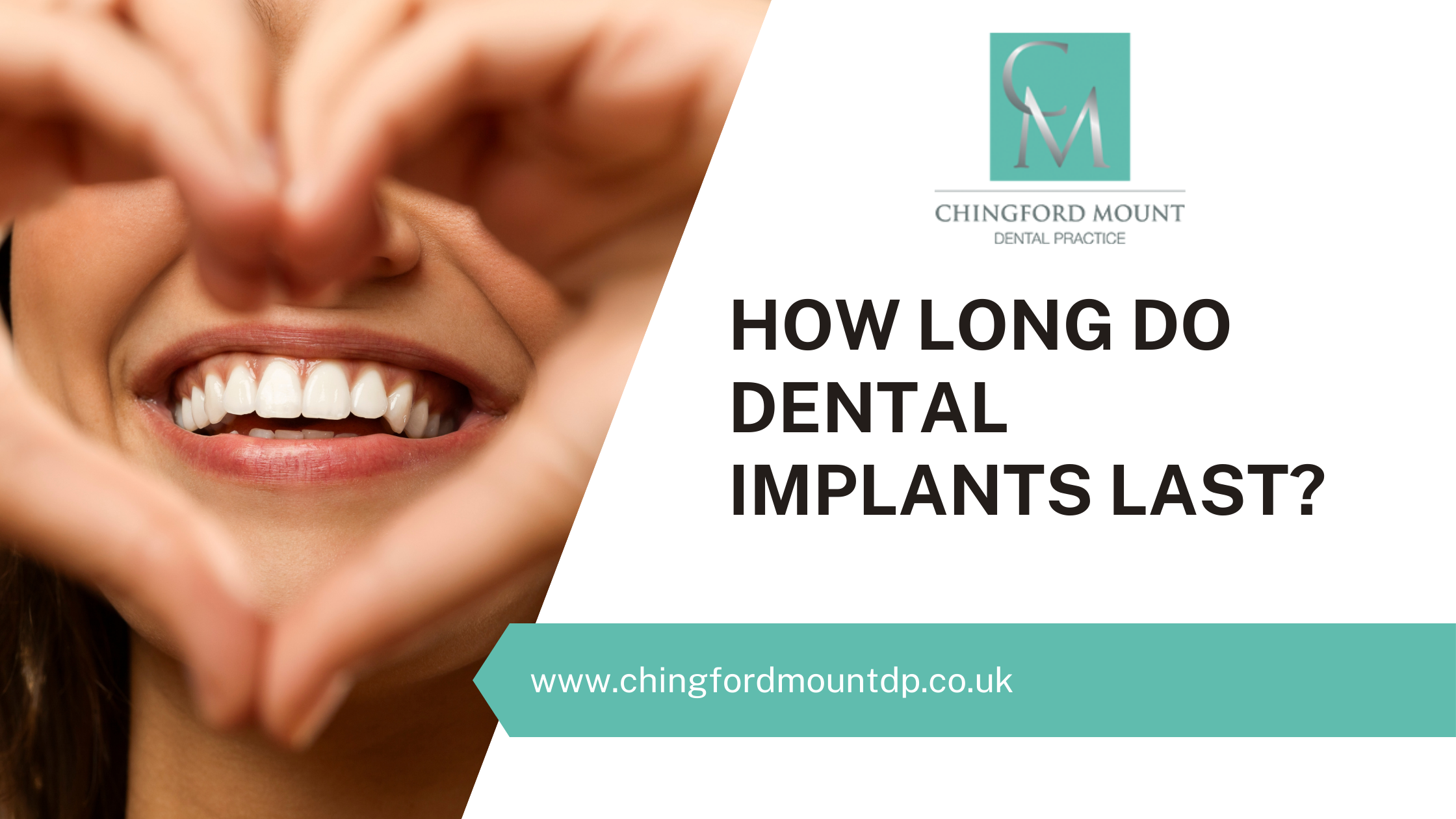 How long do dental implants last? Chingford Mount Dental Practice